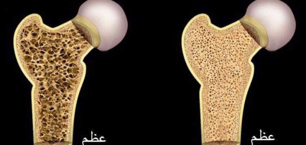 اذاعة مدرسية عن هشاشة العظام