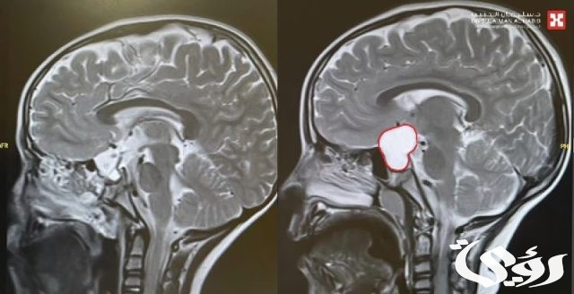 مستشفى الدكتور سليمان الحبيب بالخُبر ينقذ طفلًا من تَبِعات ورم كبير بالدماغ سبّب له صداعًا مستمرًّا وضعفًا شديدًا في النظر مستشفى الدكتور سليمان الحبيب بالخُبر ينقذ طفلًا من تَبِعات ورم كبير بالدماغ سبّب له صداعًا مستمرًّا وضعفًا شديدًا في النظر